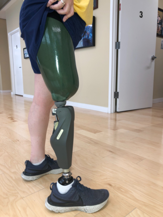 custom transfemoral above the knee prosthetic socket with MPK